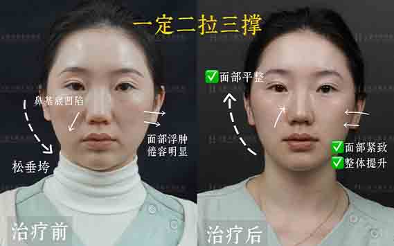 羟基玻尿酸案例